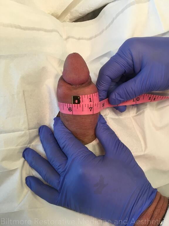 Penile Enhancement Before & After Image