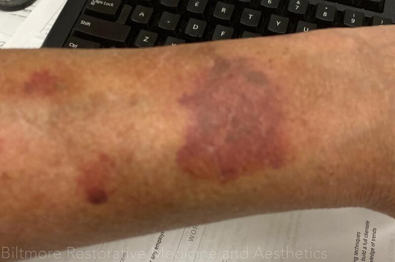 Bruises Treated Before & After Image