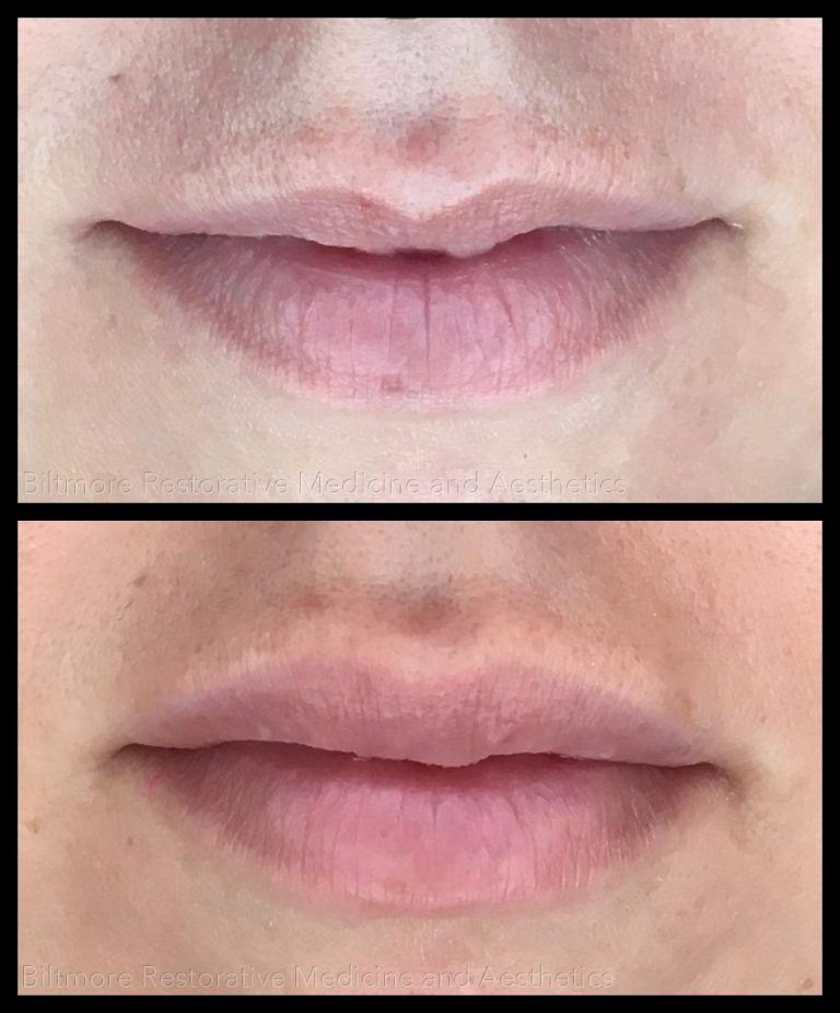 Medspa models lips before and after